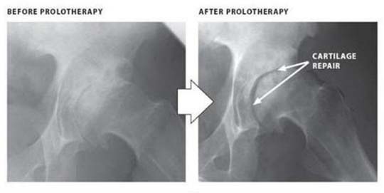 hip_x-ray.jpg